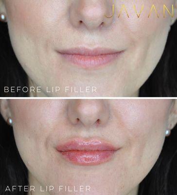 Lip Filler