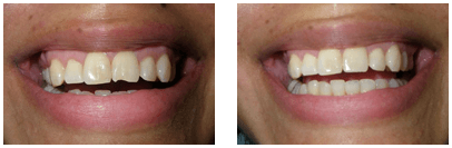 Before & After: Resin composite on a chipped tooth