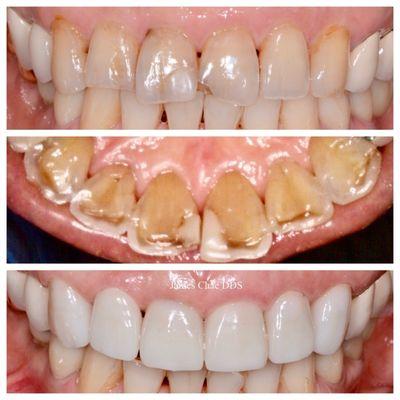 Six Emax crowns. Teeth were severely worn out without much enamel on the lingual surfaces of the teeth.