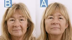 Skin tightening/Wrinkle Reduction with Exilis! 4 treatments, 2 weeks apart, NO DOWNTIME!!