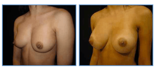 Breast Augmentation