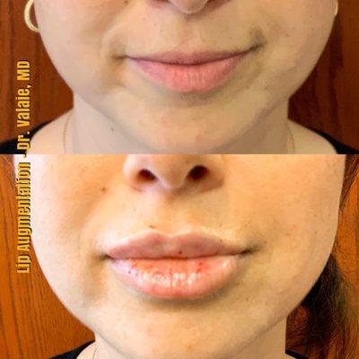 Lip Augmentation - Dr.Valaie, MD