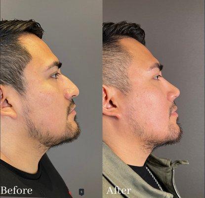 Male After 6 Months Closed Scarless Rhinoplasty + Septoplasty.