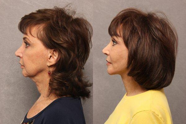 Refresher Lift with Neck Lift & Fat Transfer to Cheeks