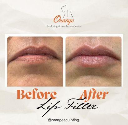 Natural Looking Results - Lip filler . Get your jawline defined with top of the line products and our experienced Aesthetic Injectors!