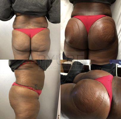 Buttock lifting, shaping, and enhancing