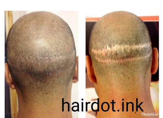 Covering scars from hair transplant