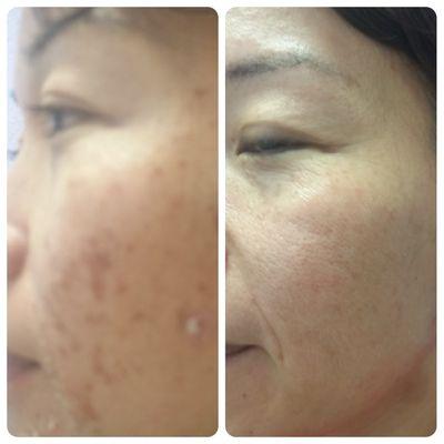 Chemical peel before & after