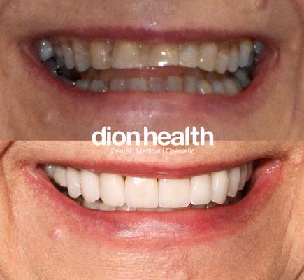 before and after of porcelain veneers