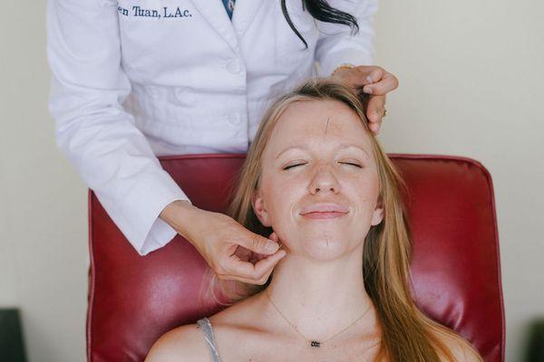 Facial acupuncture to decrease wrinkles, increase vibrancy, improve elasticity and tone on face