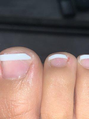 Cut from pedicure due to extreme roughness from scrapping and cutting skin around nail.