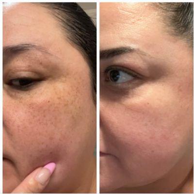 Before and after picture of Sun Damage /Sun Spot correction! We used a combination of  Hydrafacials and Hydroquinoine creams!