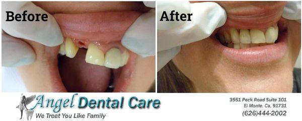 Patient A Before and After Dental Work