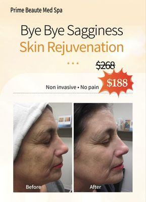 Venus legacy skin rejuvenation treatment special for 1st clients.