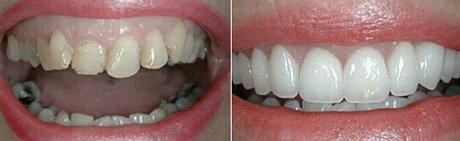 Porcelain Veneers and Gum Contouring. Only 2 appointments.