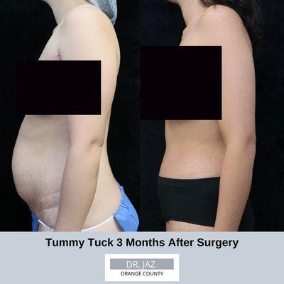 ‼Before and After‼ Patient had tummy tuck performed. Result is three months after surgery. Everything is looking good and healing well.