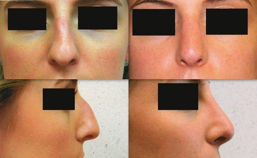 25-34 year old woman treated with Rhinoplasty (Nose Surgery)