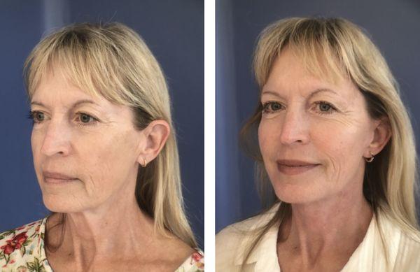 facial rejuvenation before and after results Dr. Daniel Golshani