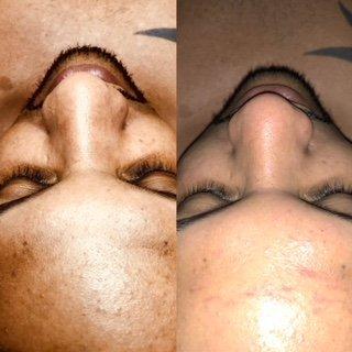 Before and after dermaplaning facial with extractions