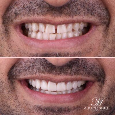 Before Veneers: Notice the visible discoloration, uneven spacing, and minor chips. Your dream smile is just a step away!