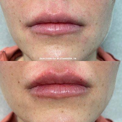 Lip Filler before and after.