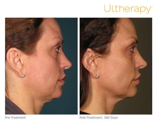 Ultherapy Rochester, NY - Neck Lift and Face Lift Results