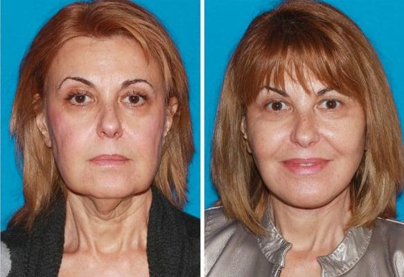 Facelift Before and After Photos