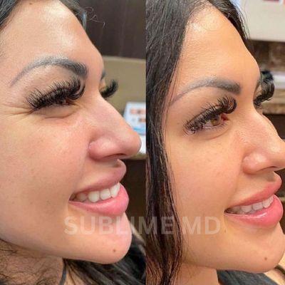 Address crows feet around the eyes with Botox