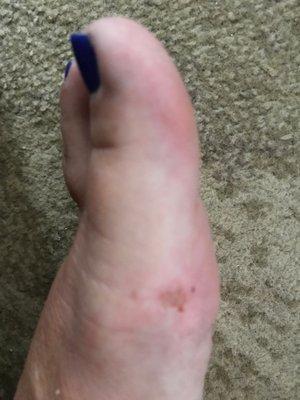 You can clearly see the skin rubbed away on my foot.