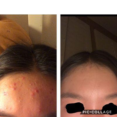 After multiple sessions of Acne treatment.