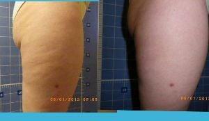 Non-Invasive Cellulite Treatment using BeautyTek
By Dr. Meschi