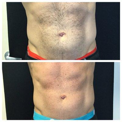 Before and after UltraSlim. Notice the definition!