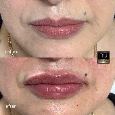 A beautiful lip transformation using Restylane Kiss