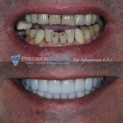 Advanced materials and techniques were used by Dr. Leo to rehabilitate his patient's dental health. The results left our patient speechless.