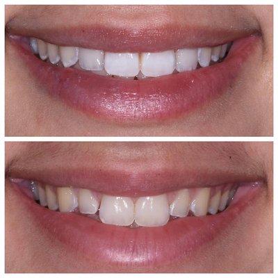 Veneers on two side teeth