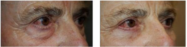 lower blepharoplasty