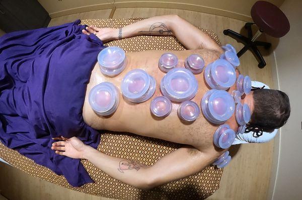 We are experts in dynamic cupping, an excellent enhancement to our Thai Sport Massage and Prehab Therapy!