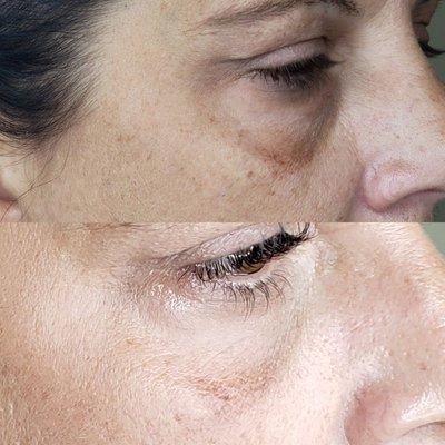 BB Glow Facial treatment. Lightened under eye circles and brightened and evened skin tone.