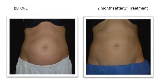 CoolSculpting Before & After