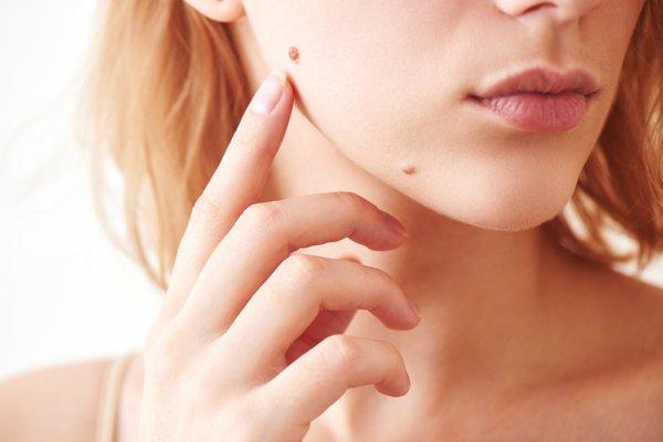 Our clinic is located in West Los Angeles and we partner with patients to provide Cosmetic Mole Removal and Cosmetic Skin Tag removal.