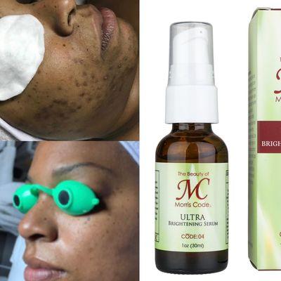 MC® Ultra Brightening Serum is very effective for Dark Spots and Hyperpigmentation (uneven skin tone)