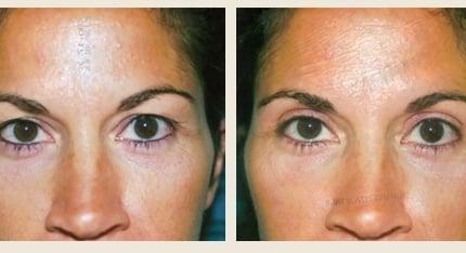 Upper Lid Blepharoplasty