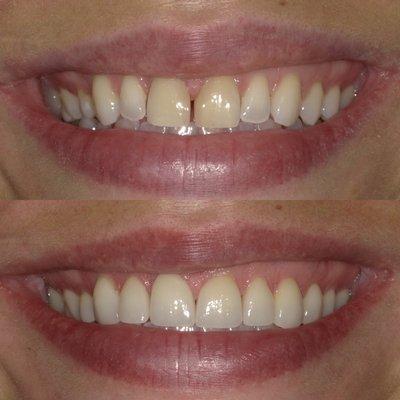 Smile improved after Invisalign and Porcelain Veneers.