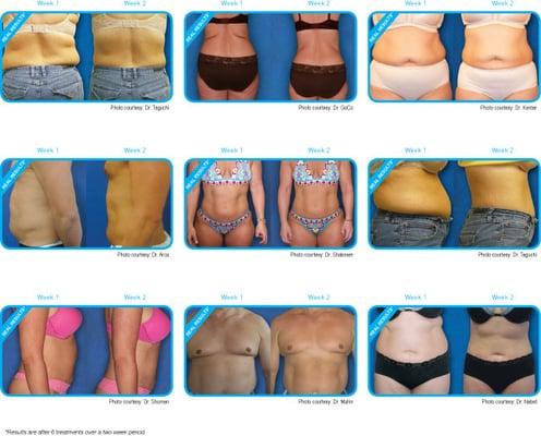 Zerona non-invasive contouring body laser.  Certified Zerona Techs.  Helping you lose inches in just 2 weeks!