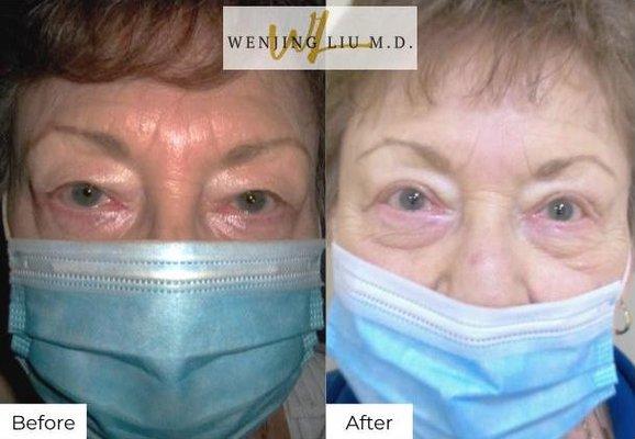 Upper eyelid lift (blepharoplasty) and lateral canthoplasty