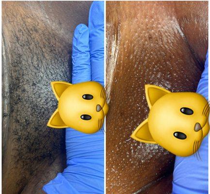 Brazilian wax