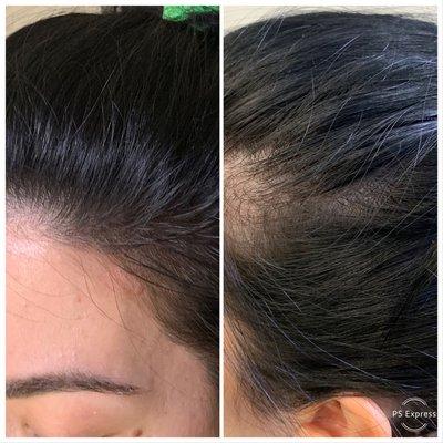 Scalp micro pigmentation for thinning sides