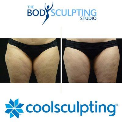 Get rid of your unwanted diet and exercise resistant fat with CoolSculpting at The Body Sculpting Studio.