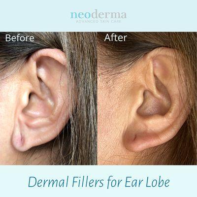 Elevate your elegance from lobe to love! Dermal fillers for earlobes, because every detail counts.