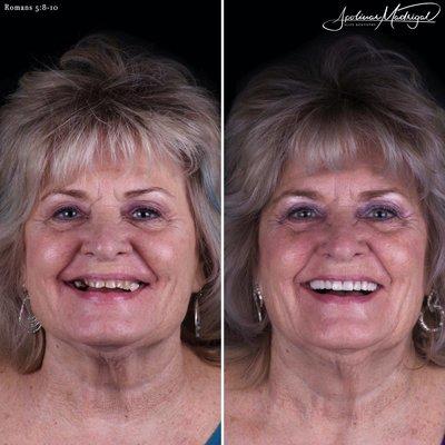 Smile Makeover with porcelain crowns and veneers